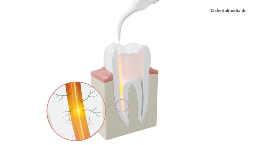 Laserbehandlung Wurzelbehandlung